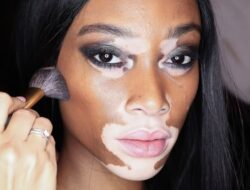 Vitiligo: Fakta Stres Berat dan Penyebarannya