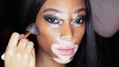 Vitiligo: Fakta Stres Berat dan Penyebarannya