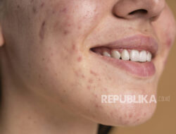 FOMO Skincare: Waspadai Risiko Fungal Acne pada Kulit Anda