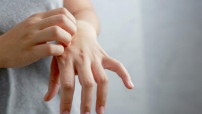 Dermatolog: Mengapa Anxiety Bisa Picu Jerawat dan Eksim?